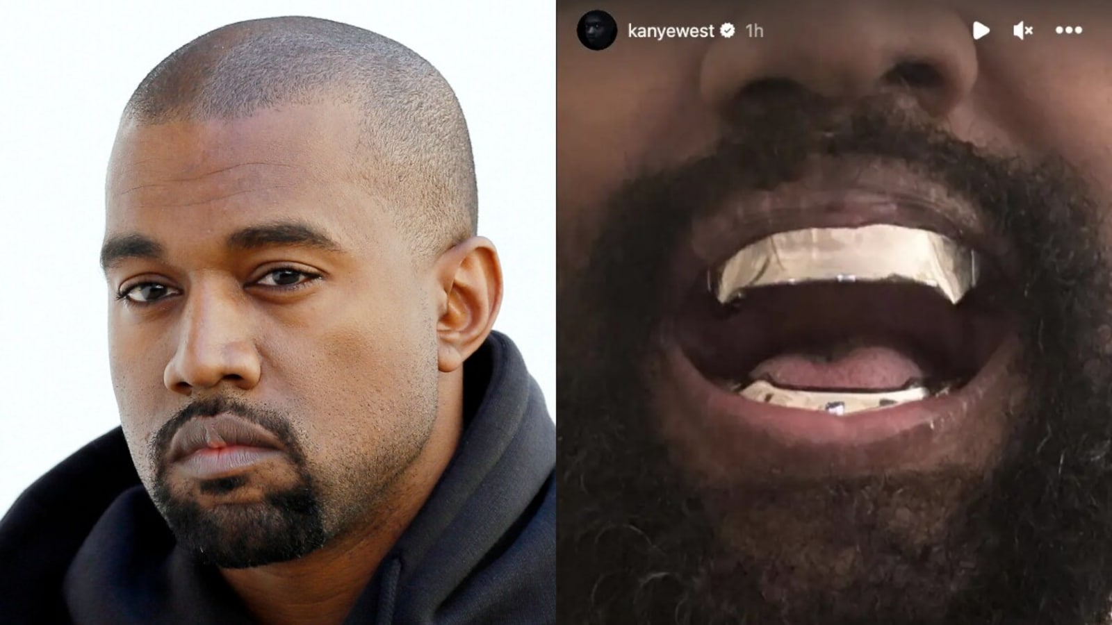 Kanye West reportedly replaced his teeth with $850k James Bond-inspired Titanium dentures 6 www.talentsofworld.com | Talentsofworld Articles
