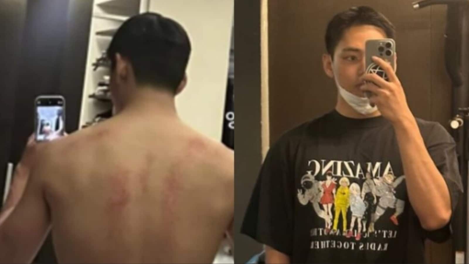 BTS' Kim Taehyung shares pics of his ‘buffed up’ bare back with ‘wound of glory’; gives update on life. See photos