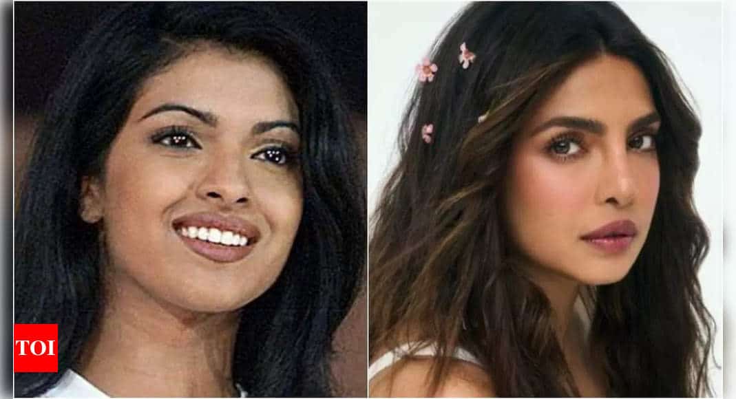 Surgery gone wrong: When Priyanka Chopra’s honest confession on her botched nose surgery reminded of its consequences | Hindi Movie News - Times of India 8 Surgery gone wrong: When Priyanka Chopra’s honest confession on her botched nose surgery reminded of its consequences | Hindi Movie News - Times of India