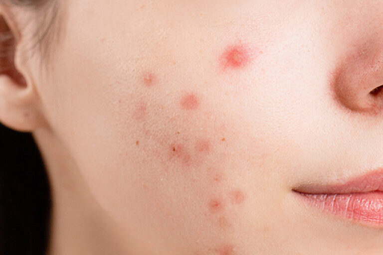 Advanced Acne Scar Treatment in Hauz Khas – Get Clear, Smooth Skin with Iksana Wellness 1 Advanced Acne Scar Treatment in Hauz Khas – Get Clear, Smooth Skin with Iksana Wellness