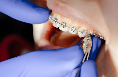 Does Orthodontic Treatment Hurt? Here’s the Truth 4 Does Orthodontic Treatment Hurt Here’s the Truth