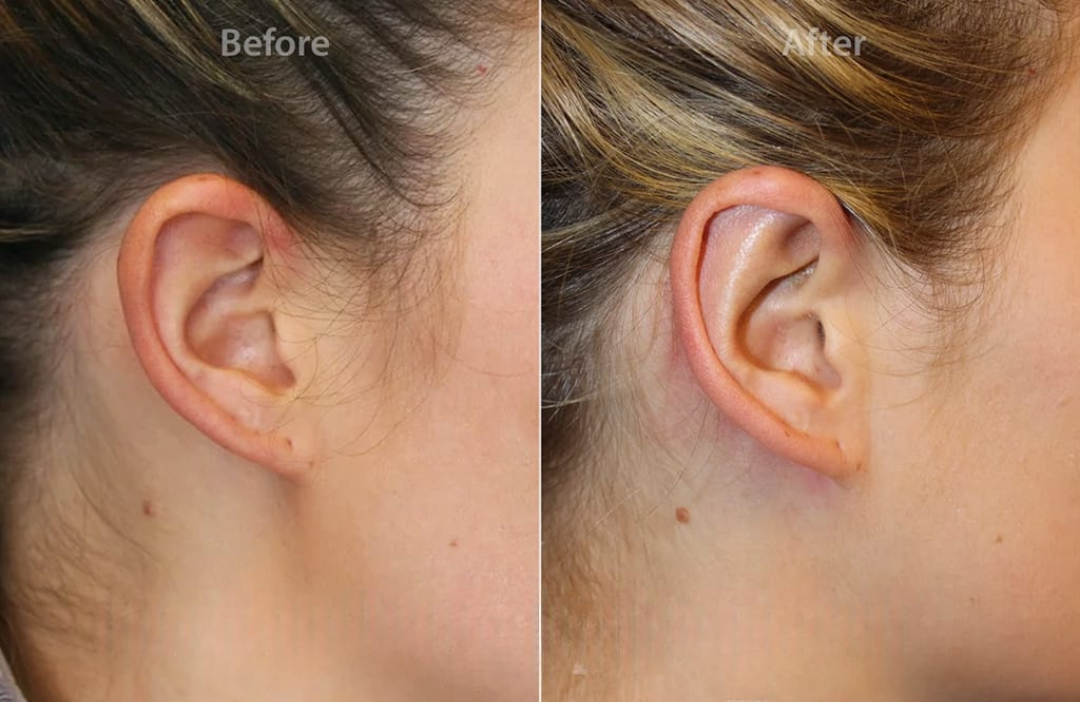 Ear Reshaping in Islamabad: Procedure, Recovery & Results 8 Ear Reshaping in Islamabad
