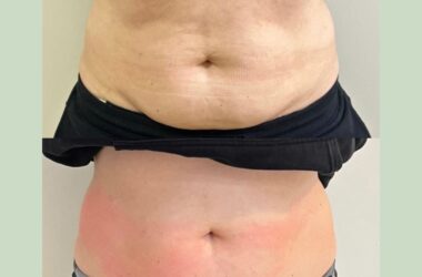 Redefine Your Waistline with Tummy Tuck in Islamabad 4 tummy tuck surgery in islamabad