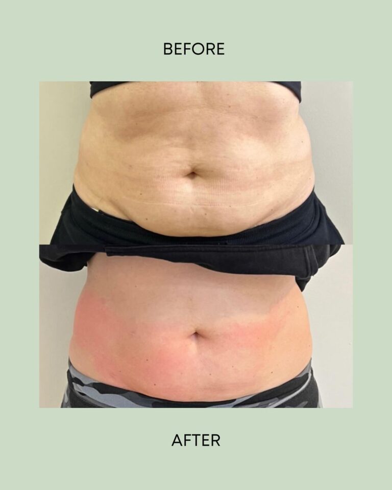 Redefine Your Waistline with Tummy Tuck in Islamabad 1 tummy tuck surgery in islamabad